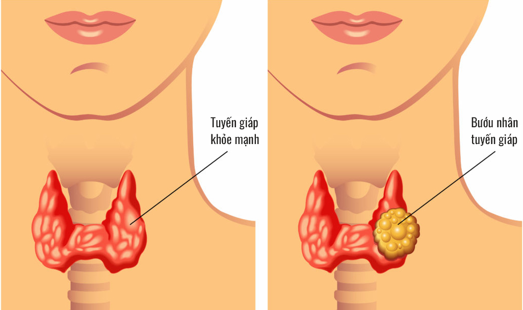 3. Chẩn Đoán Bệnh U Xơ Tuyến Giáp